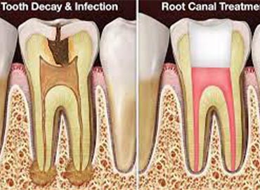 Pain Free Root Canal Treatment in India